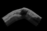 Extended field of view showing the extent of isoechoic and hyperechoic signal on gray scale