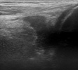 Anterior longitudinal view right knee over the medial gutter