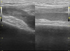 Comparison between the affected and non-affected knee, suprpatella recess