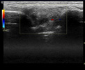 Power doppler of the right elbow showing low grade power doppler signal