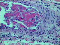 Skin biopsy showing fibrin thrombin occluding the vessel along with the presence of neutrophils and lymphocytes within the vessel wall
