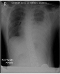 CXR: Moderate to large left pleural effusion