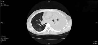 Chest CT: Large left pleural effusion, right sided pulmonary fibrosis with basilar predominance and patchy distribution in RUL with small paraseptal bullae c/w IPF.